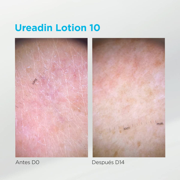 ISDIN Ureadin Lotion 10 (1000ml) | Loțiune de corp cu hidratare intensivă pentru pielea uscată 10% uree