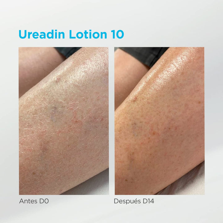ISDIN Ureadin Lotion 10 (1000ml) | Loțiune de corp cu hidratare intensivă pentru pielea uscată 10% uree